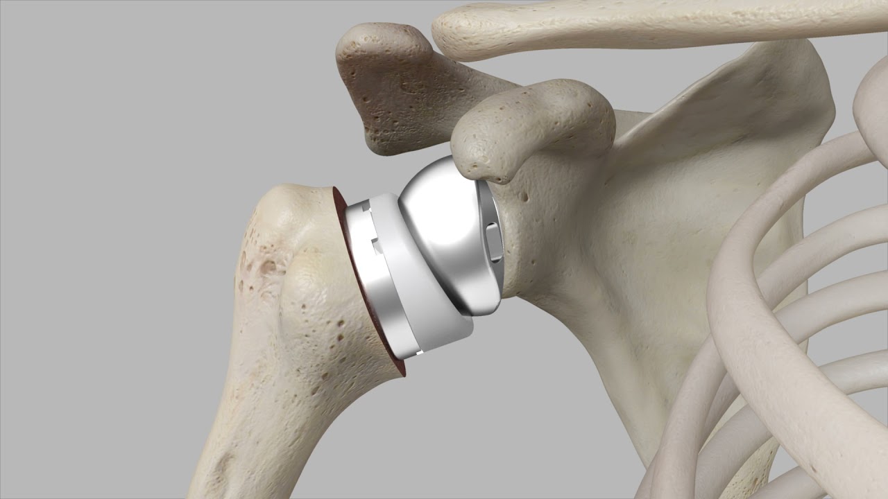 Total Kalça Protezi Nedir?