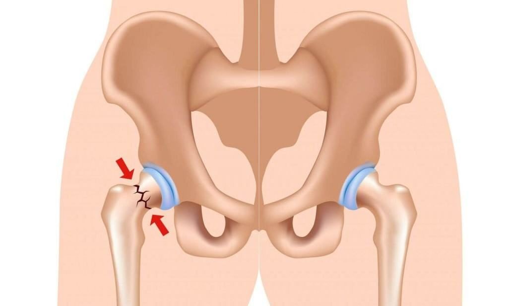 Kalça Çıkığı Nedir?